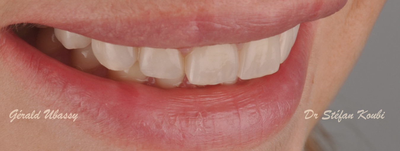 veneers and crowns /Dr Stefan Koubi